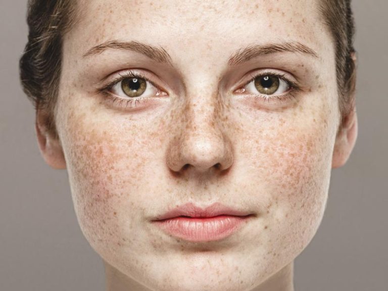 Rosacea