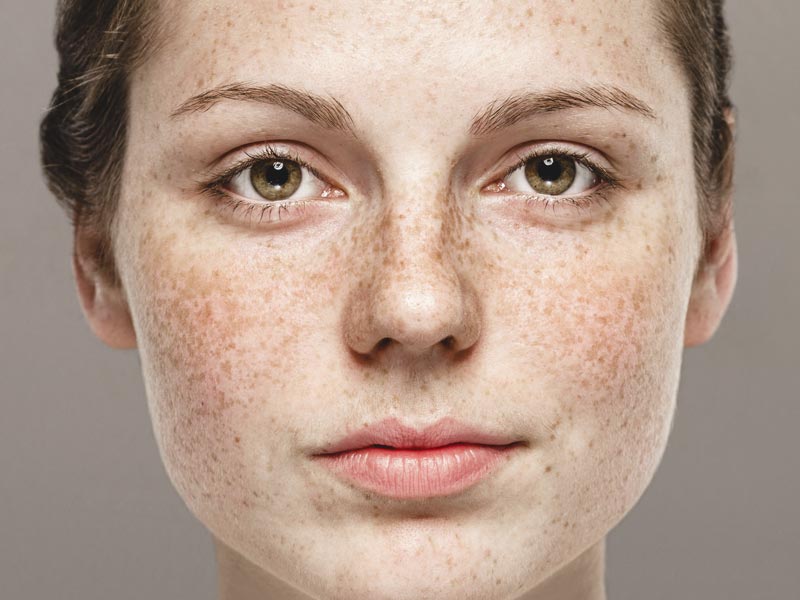 Rosacea